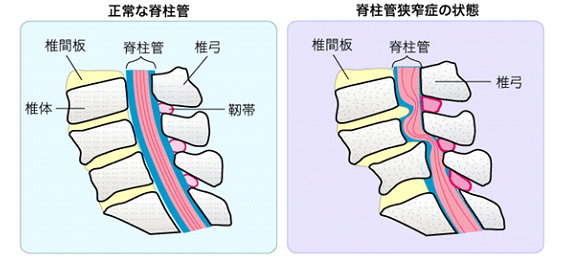 正常な脊柱管　脊柱管狭窄症の状態